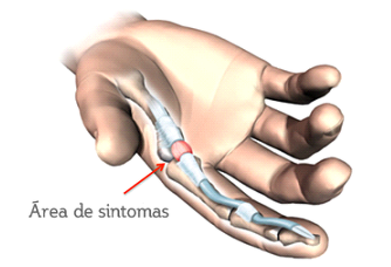 O que é a tenossinovite estenosante ou Dedo em Gatilho